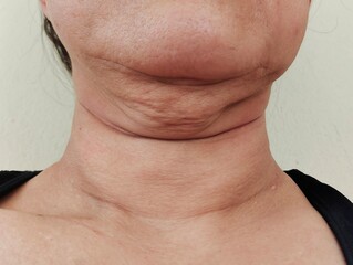 Portrait of the wrinkle under the neck, problem skin on the chin.