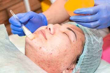 A woman with problem skin on her face, on cosmetic procedures by a dermatologist beautician, does a...