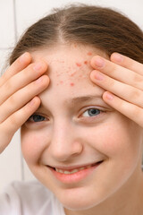 Fototapeta premium portrait of a teenage girl touches her face with pimples, acne on the skin, she laughs and has good emotions