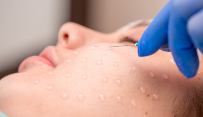 Cosmetology mesotherapy for facial rejuvenation. Mikronidling cosmetic procedure. The beautician...