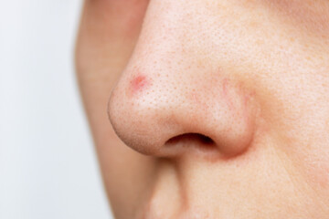 Close-up of a woman's nose with blackheads or black dots and a red inflamed pimple isolated on a...