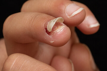 Finger nail come-off after injury or disease