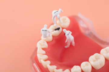Dental caries found by micro examiner