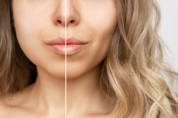 Cropped shot of young caucasian blonde woman with wavy hair before and after plastic surgery buccal...