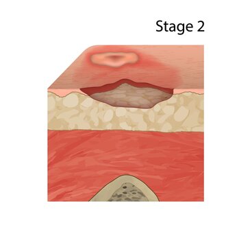 Stage 2 pressure sore, illustration