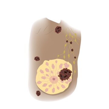Female breast cancer T4, illustration