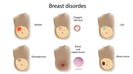 Female breast disorders, illustration