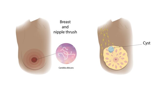 Cyst and thrush comparison, illustration