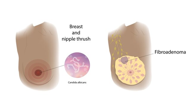 Fibroadenoma and thrush comparison, illustration