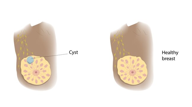 Healthy breast and cyst, illustration