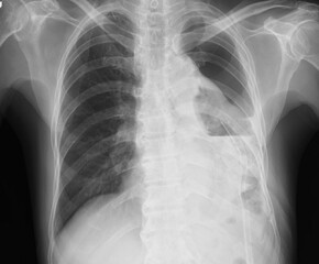 x ray image of hydropneumothorax,fluidneumothorax