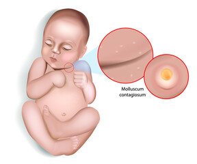 Molluscum contagiosum virus infection. Water warts. Molluscum contagiosum virus on the skin of an infant