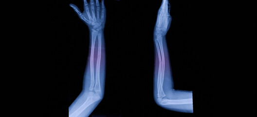 A photo of plain radiograph on dark background in hospital. The film use for diagnosis the illness of patient.Medical concept. A children with fracture distal ulnar bone. A green stick fracture. - obrazy, fototapety, plakaty