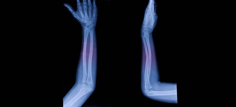 A photo of plain radiograph on dark background in hospital. The film use for diagnosis the illness of patient.Medical concept. A children with fracture distal ulnar bone. A green stick fracture.