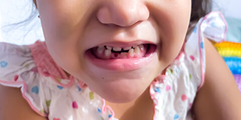 Little girl showing fallen tooth