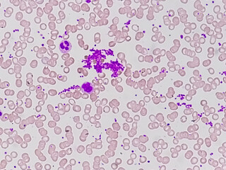 Giant platelet disorders are rare disorders featuring abnormally large platelets, thrombocytopenia...