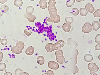 Giant platelet disorders are rare disorders featuring abnormally large platelets, thrombocytopenia...
