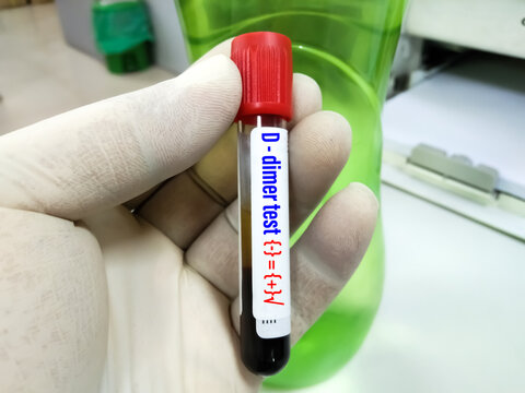 Test Tube With Positive Blood Sample For D-dimer Test, Diagnosis For Disseminated Intravascular Coagulation