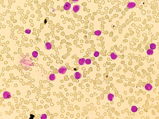 Leuco-erythroblastic anaemia and Chronic myelomonocytic leukemia (CMML), MPD, Blood smear under...