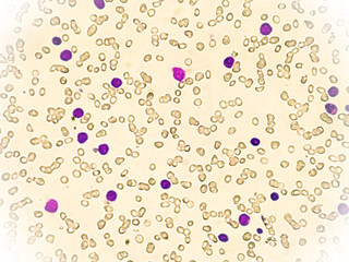 Leuco-erythroblastic anaemia and Chronic myelomonocytic leukemia (CMML), MPD, Blood smear under...