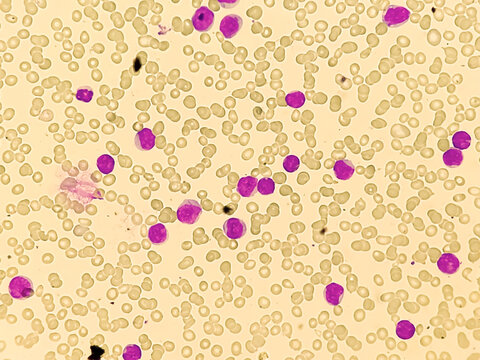 Leuco-erythroblastic anaemia and Chronic myelomonocytic leukemia (CMML), MPD, Blood smear under microscope