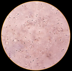 Sperm morphology. Semen photo under microscope. Micrograph showing spermatozoons