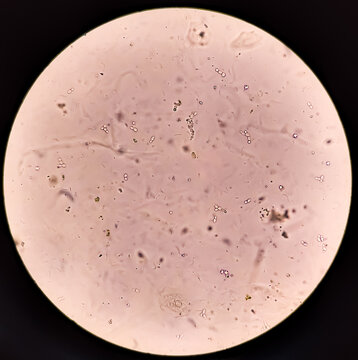 Sperm morphology. Semen photo under microscope. Micrograph showing Azoospermia