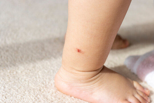 足の虫刺されをひっかいた赤ちゃんの足(1歳5か月、女の子、日本人）