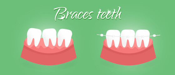 Braces teeth.Dental concept.flat vector illustration of the rules for teeth alignment