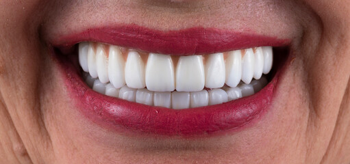 zirkon ceramic crowns on implants