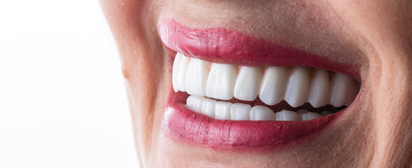zirkon ceramic crowns on implants