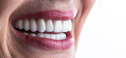 Fototapeta premium zirkon ceramic crowns on implants