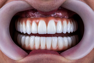 zirkon ceramic crowns on implants