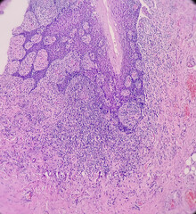 Tongue with mandible cancer, oral cancer, Invasive squamous cell carcinoma, grade-II. Lymphovascular invasion present, microscopic view. - obrazy, fototapety, plakaty