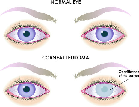 Medical illustration of one of the possible consequences of corneal leucoma on the eye.