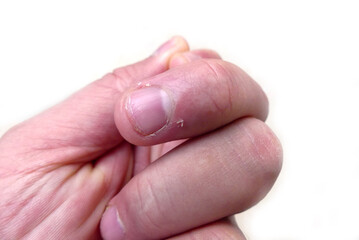 skin peeling on finger nails, vitamin C deficiency and nail skin diseases,