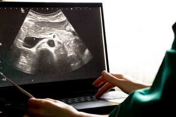 Ultrasound of a woman's abdomen on a laptop screen monitor in a doctor's office, diagnostics of an...