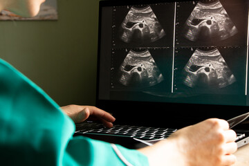 Ultrasound of a woman's abdomen on a laptop screen monitor in a doctor's office, diagnostics of an...