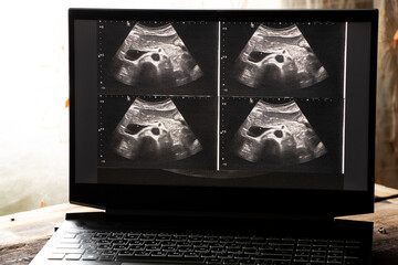 Ultrasound of a woman's abdomen on a laptop screen monitor in a doctor's office, diagnostics of an...