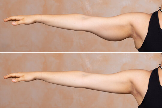 Upper Arm Liposuction: Everything You Need to Know