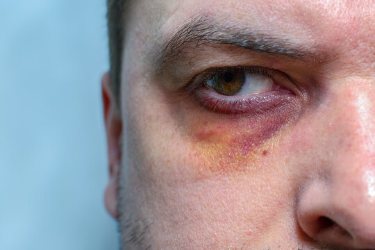 A man with a black eye, after a fight or an accident.Eye injury