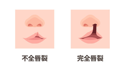 口唇口蓋裂_不全唇裂と完全唇裂のイラスト_アップ