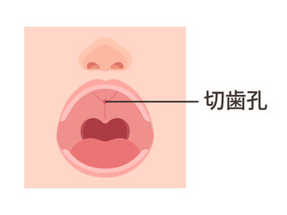 切歯孔のイラスト_アップ_開口_口腔