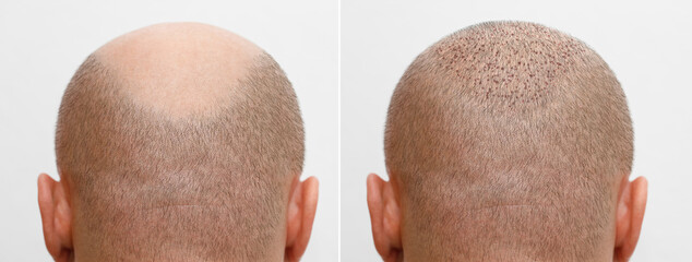 The head of a balding man before and after hair transplant surgery. A man losing his hair has become shaggy. An advertising poster for a hair transplant clinic. Treatment of baldness. - obrazy, fototapety, plakaty