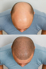 The head of a balding man before and after hair transplant surgery. A man losing his hair has become shaggy. An advertising poster for a hair transplant clinic. Treatment of baldness.