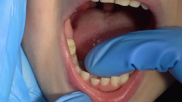A doctor in blue gloves examines the child's mouth, the tooth is wobbling, followed by a new tooth.