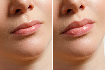 A woman makes lip shape correction in a cosmetology clinic. Lips injections, lip augmentation. - obrazy, fototapety, plakaty