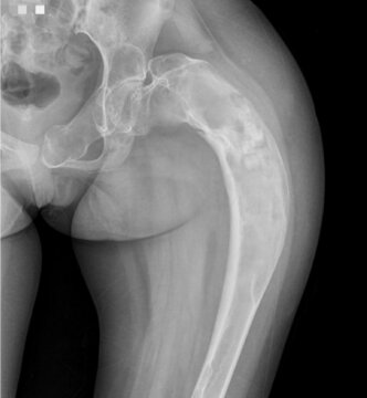 X Ray Of A Fibrous Dysplasia 