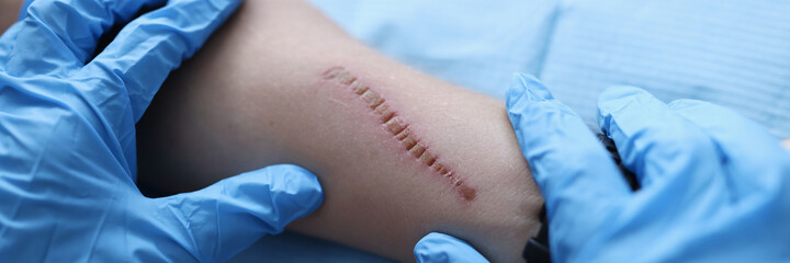 Doctor surgeon in protective medical gloves examining scar on patient hand closeup