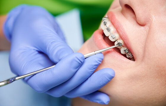 Close up of dentist hand using dental forceps while putting orthodontic braces on female patient teeth. Woman having dental procedure in clinic. Concept of dentistry and orthodontic treatment.